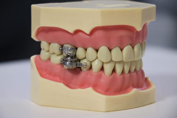 DentalSlim Diet Control, perangkat intra-oral ini dipasang oleh seorang profesional gigi pada gigi belakang atas dan bawah.