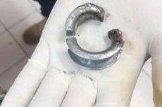 Pasang Cincin Baja di Alat Kelamin untuk Buat Pacar Terkesan, Pria Ini Berakhir di Rumah Sakit