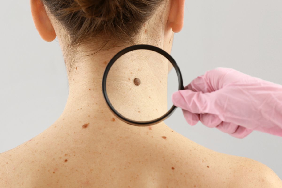 Ilustrasi kanker kulit melanoma. Kanker kulit ini bisa saja muncul karena beberapa kebiasaan buruk, seperti merokok dan tidak memakai tabir surya.  