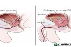 Teknologi Baru Pengobatan Kanker Prostat