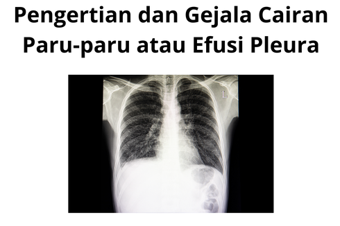 Pengertian dan Gejala Cairan Paru-paru atau Efusi Pleura