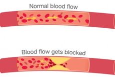 Pembuluh Darah Jantung Bisa Tersumbat Lagi Setelah Pasang Ring?