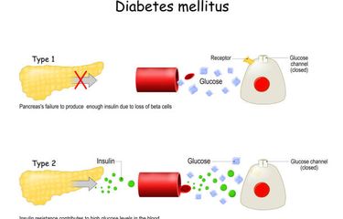 Pebedaan diabetes tipe 1 dan tipe 2.