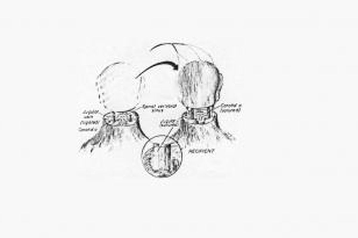 Ilustrasi cangkok kepala yang dilakukan pada monyet rhesus tahun 1970 oleh Robert White dan rekan. 