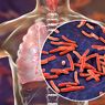 Pakar UGM: Angka TBC Turun Selama Pandemi Covid-19
