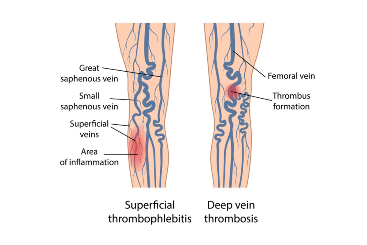 Ilustrasi tromboflebitis