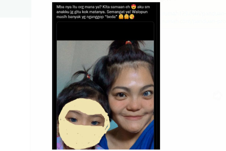 Tangkapan layar foto ibu dan anak yang mengalami sindrom Waardenburg viral di media sosial pada Senin (28/2/2022).