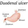Ulkus Duodenum