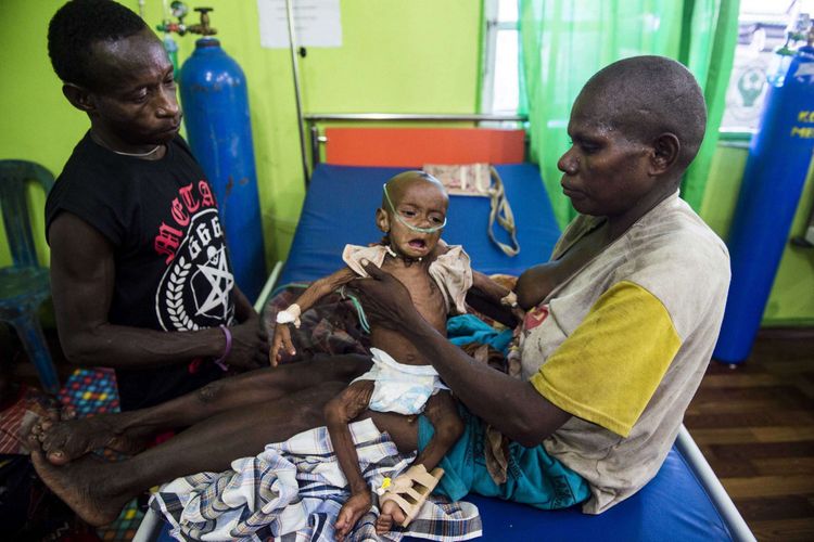 Warga menggendong anaknya saat dirawat di Rumah Sakit Umum Daerah (RSUD) Agats, Kabupaten Asmat, Papua, Senin (22/1/2018). Jumlah anak penderita gizi buruk dan campak yang dirawat di kawasan tersebut sebanyak 85 orang diantaranya di RSUD Agats 40 anak dan 45 anak di aula gereja Protestan Indonesia.