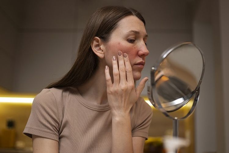 Rosacea adalah masalah kulit yang menyebabkan timbul kemerahan pada wajah dan benjolan kecil berisi nanah. Lantas, apakah rosacea bisa sembuh?