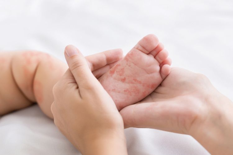 Kutai Timur Resmi Berstatus KLB Campak, Kenali Lagi Gejala dan Faktor Risikonya