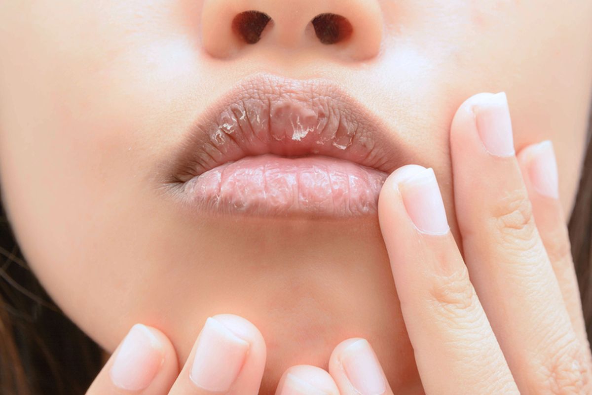 Ilustrasi bibir kering, tips agar bibir tidak kering saat puasa
