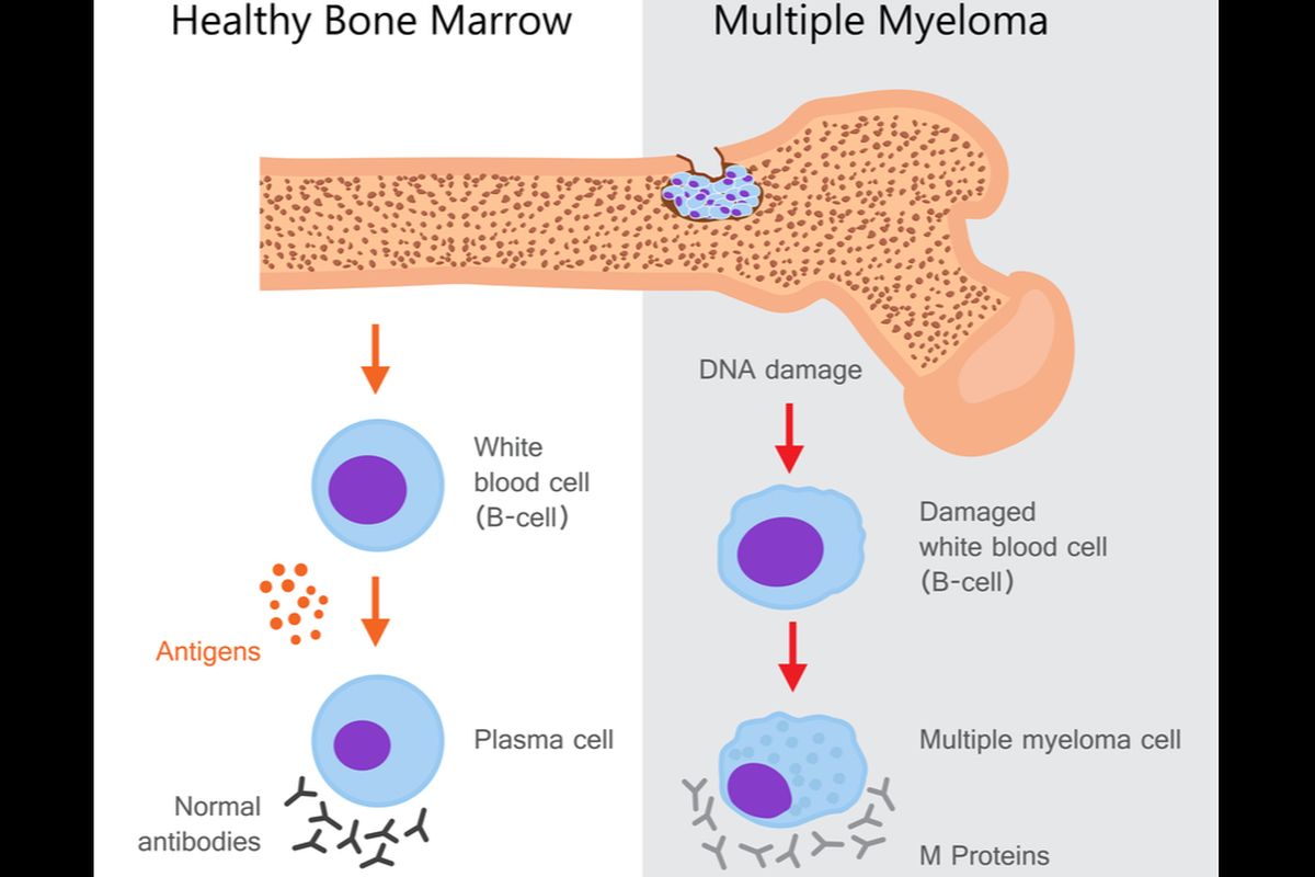 Ilustrasi multiple myeloma