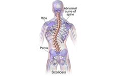 2 Cara Mengatasi Skoliosis yang Perlu Diketahui