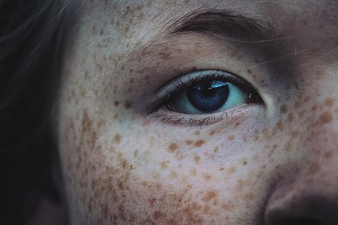 Freckles