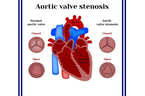 Stenosis Aorta