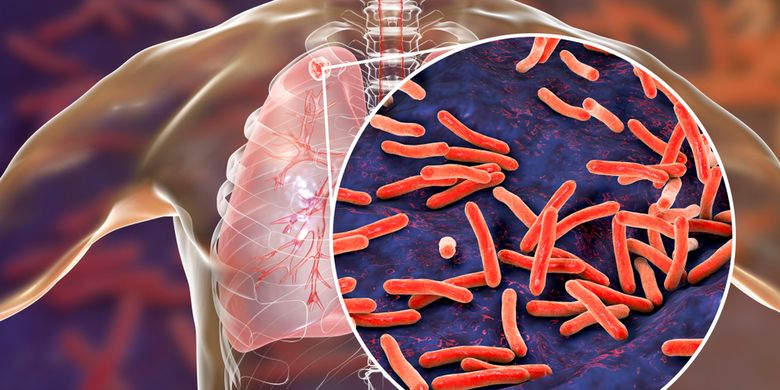 Paru paru seorang pasien setelah dianalisis ternyata ditemukan bakteri mycobacterium tuberculosis