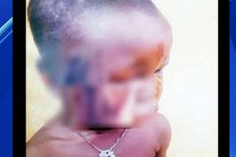 wajah bocah perempuan lima tahun yang menjadi korban penganiayaan ayahnya di Lagos, Nigeria. 