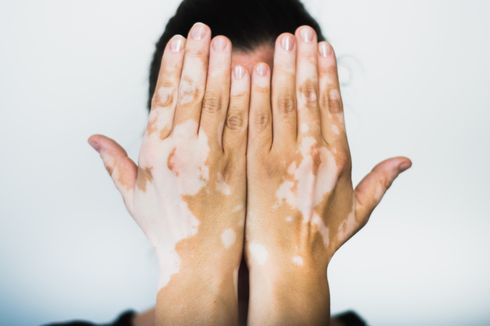 Vitiligo, Penyakit Kulit Tak Menular yang Bikin Bercak Putih Muncul