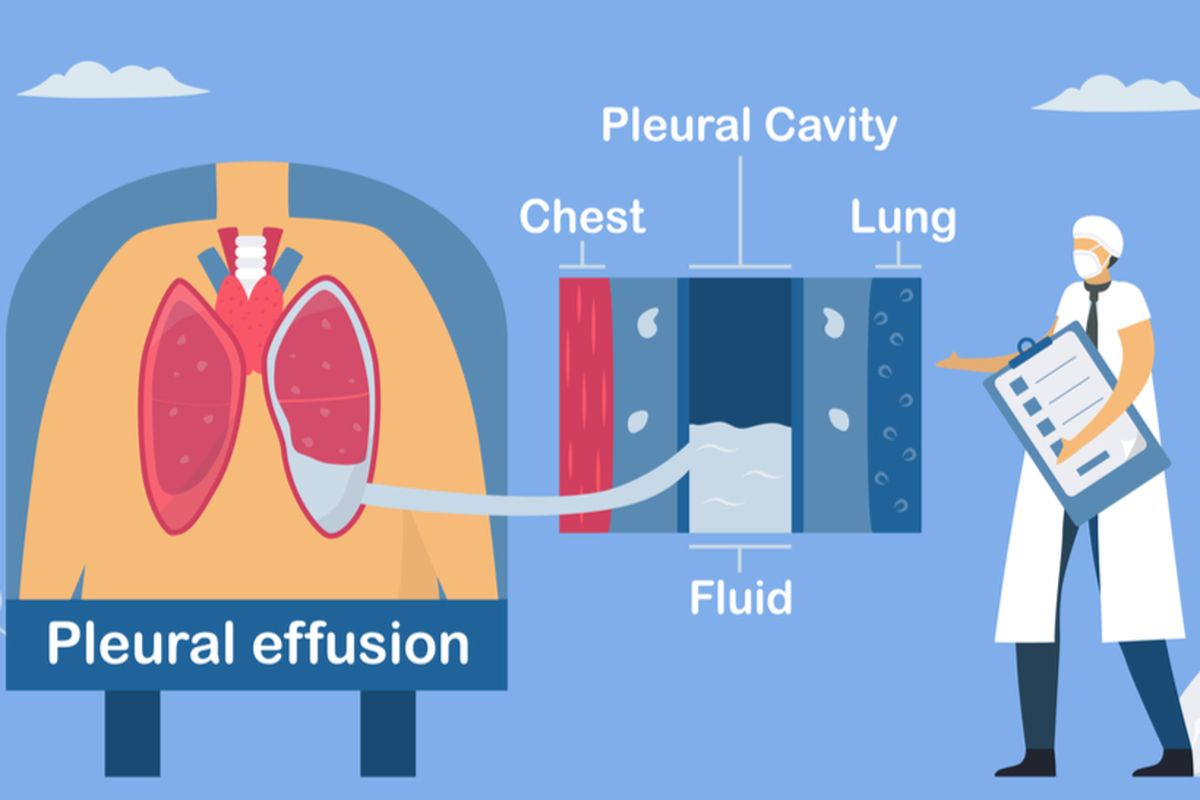 Ilustrasi efusi pleura