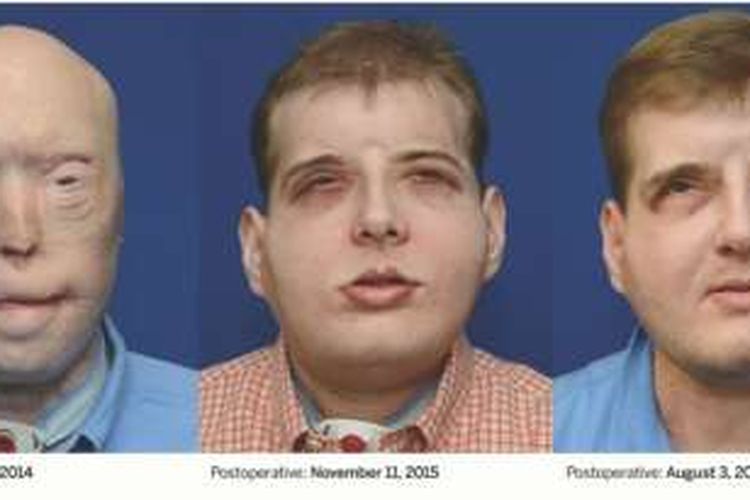 Pat Hardison, sebelum operasi cangkok wajah dan setahun setelahnya.
