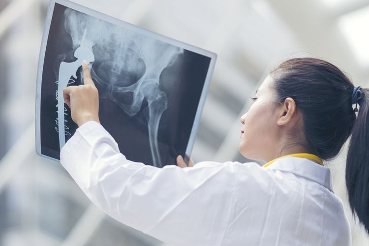 Seorang dokter sedang memeriksa hasil X Ray pasien kanker tulang