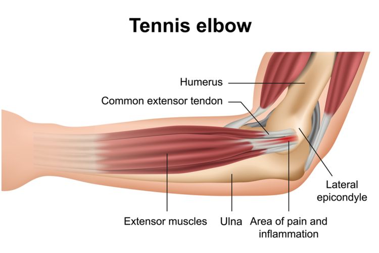 Ilustrasi Tennis elbow
