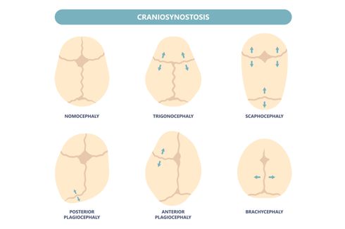Kelainan Bentuk Kepala Bayi Craniosynostosis: Gejala, Ciri, dan Penanganan