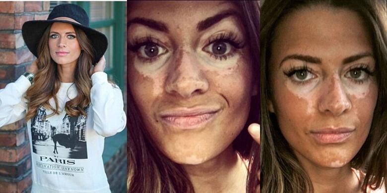 Kondisi kulit vitiligo model bernama Breanne Rice