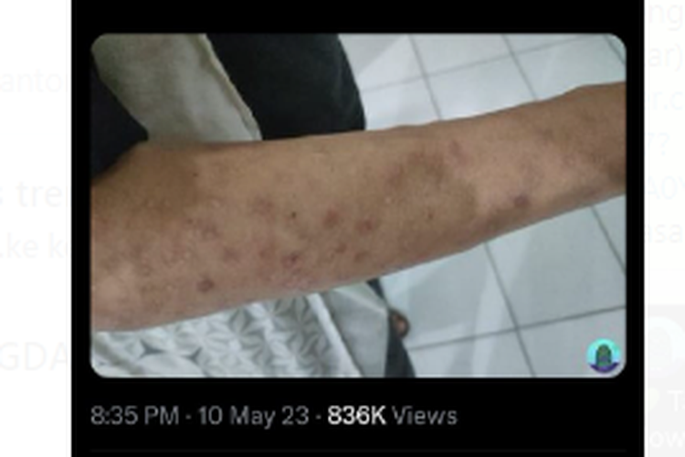 Tangkapan layar twit soal banyak bekas luka disebut gejala sifilis. Apakah bisa dibedakan dengan gejala penyakit kulit lainnya?
