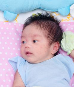 Kulit Bayi Beruntusan, Ketahui Penyebab dan Cara Mengatasinya