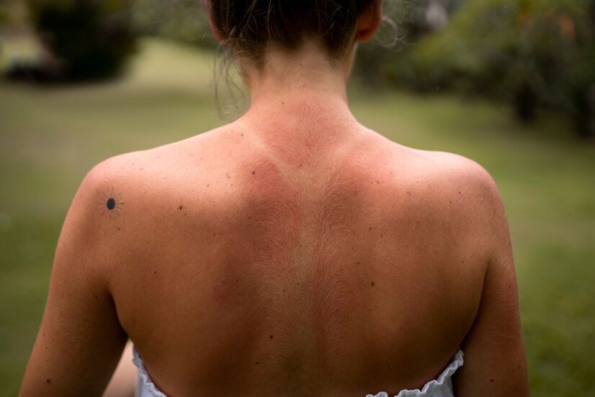 Ilustrasi kulit yang mengalami sunburn