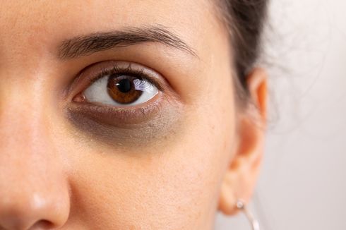 9 Obat Alami untuk Menghilangkan Lingkaran Hitam di Bawah Mata