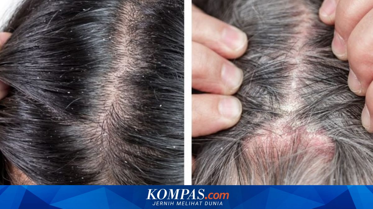 Psoriasis Kulit Kepala dan Ketombe, Apa Bedanya?