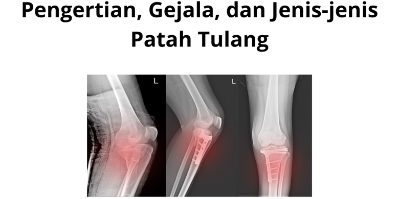 Pengertian Gejala Dan Jenis Jenis Patah Tulang