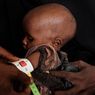 15 Negara Ini Sumbang 30 Juta Kasus Malnutrisi Akut pada Anak, PBB Serukan Bantuan Mendesak