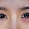 12 Penyebab Kelopak Mata Bengkak dan Cara Mengatasinya