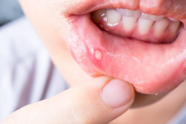 ilustrasi lesi di mulut yang bisa menjadi gejala infeksi HPV di mulut.