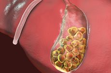 Batu Empedu Bisa Keluar dengan Cara Apa? Simak Penjelasannya Berikut