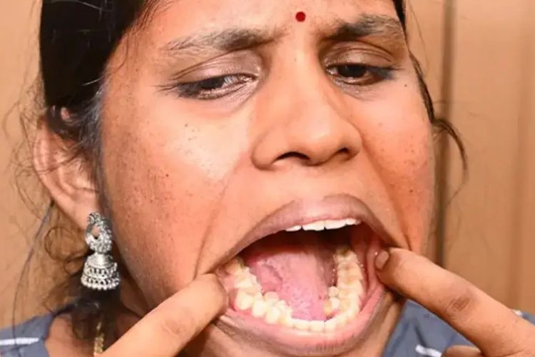Kalpana Balan saat ini memegang rekor untuk jumlah gigi terbanyak di mulut seorang wanita, yakni 38 buah.