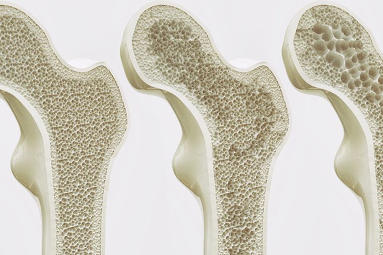 Ilustrasi osteoporosis. Sejumlah cara bisa Anda lakukan untuk mencegah osteoporosis yang semakin berisiko seiring bertambahnya usia.