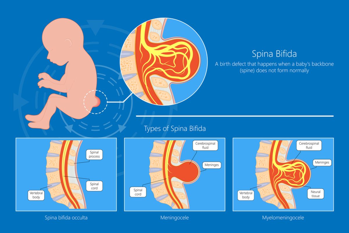 Ilustrasi spina bifida