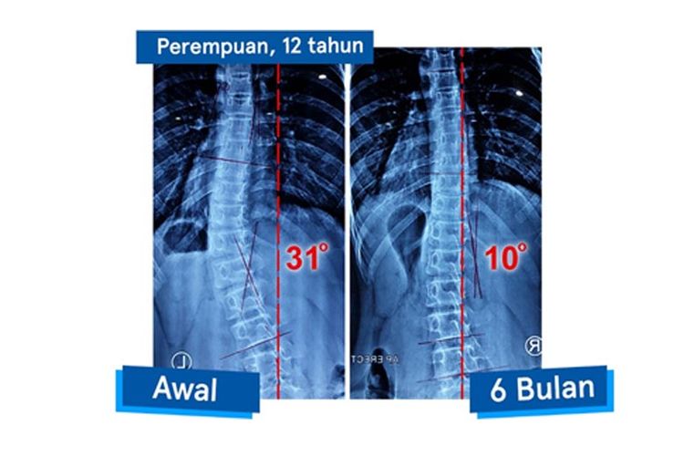 Ilustrasi sebelum dan sesudah penderita skoliosis melakukan Latihan Schroth dan menggunakan Brace Gensingen.
