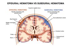 Hematoma Subdural