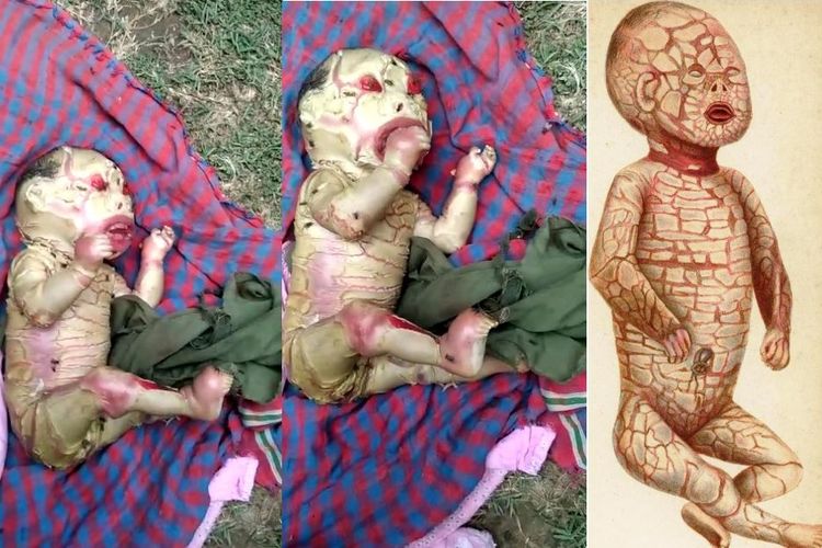 Kiri dan tengah: penampakan bayi dengan Harlequin ichthyosis dalam video yang viral. Kanan: Ilustrasi Harlequin ichthyosis