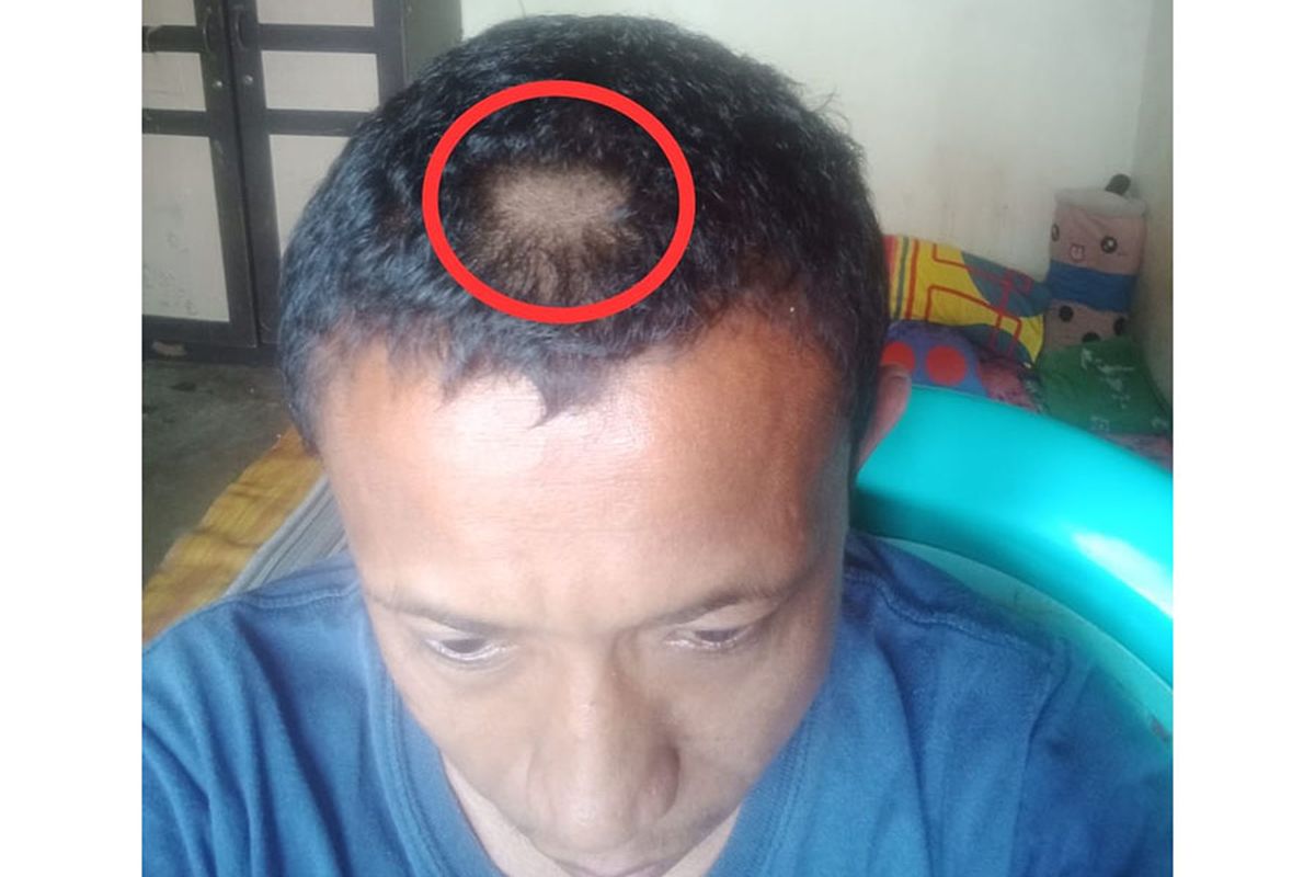 Kondisi rambut Pak Guru Ulan Hadji yang digunting paksa (dilingkari) oleh orang tua siswanya karena telah menggunting rambut siswanya yang dinilai panjang. Guru SDN 13 Paguyaman ini juga bahkan dimintai pernyataan bersalah.