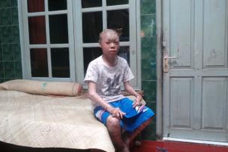 Ari Wibowo (17) remaja di Tangerang Selatan yang memiliki kulit seperti sisik ular.