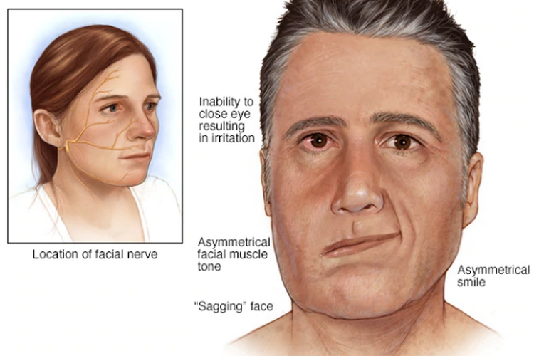 Ilustrasi bells palsy