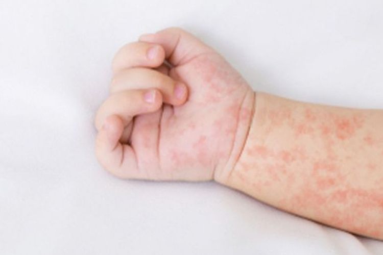 90 Warga Sampang Diduga Terserang Campak, 11 Sampel Diuji ke BBLK Surabaya