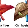 Jenis Kanker Hati yang Bisa Diobati tanpa Operasi